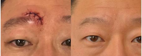 before_and_after_eyebrow