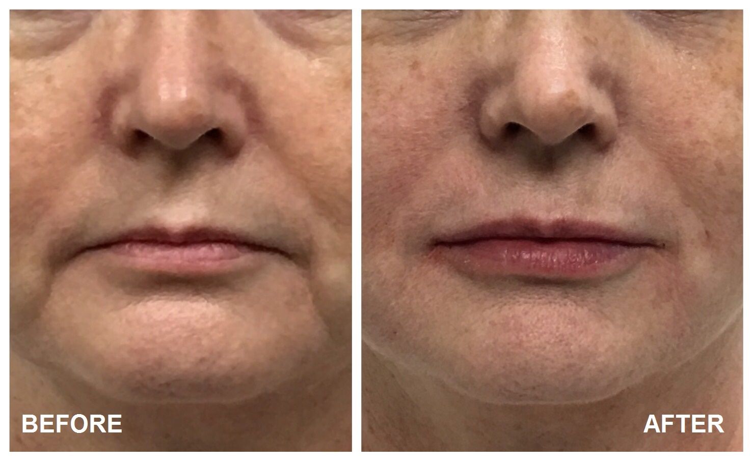 fillers-before-after-image