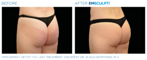 Emsculpt Neo Treatment Before and After
