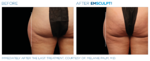 Emsculpt Neo Treatment Before and After