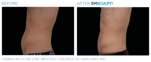 Emsculpt Neo Treatment Before and After Abdomen