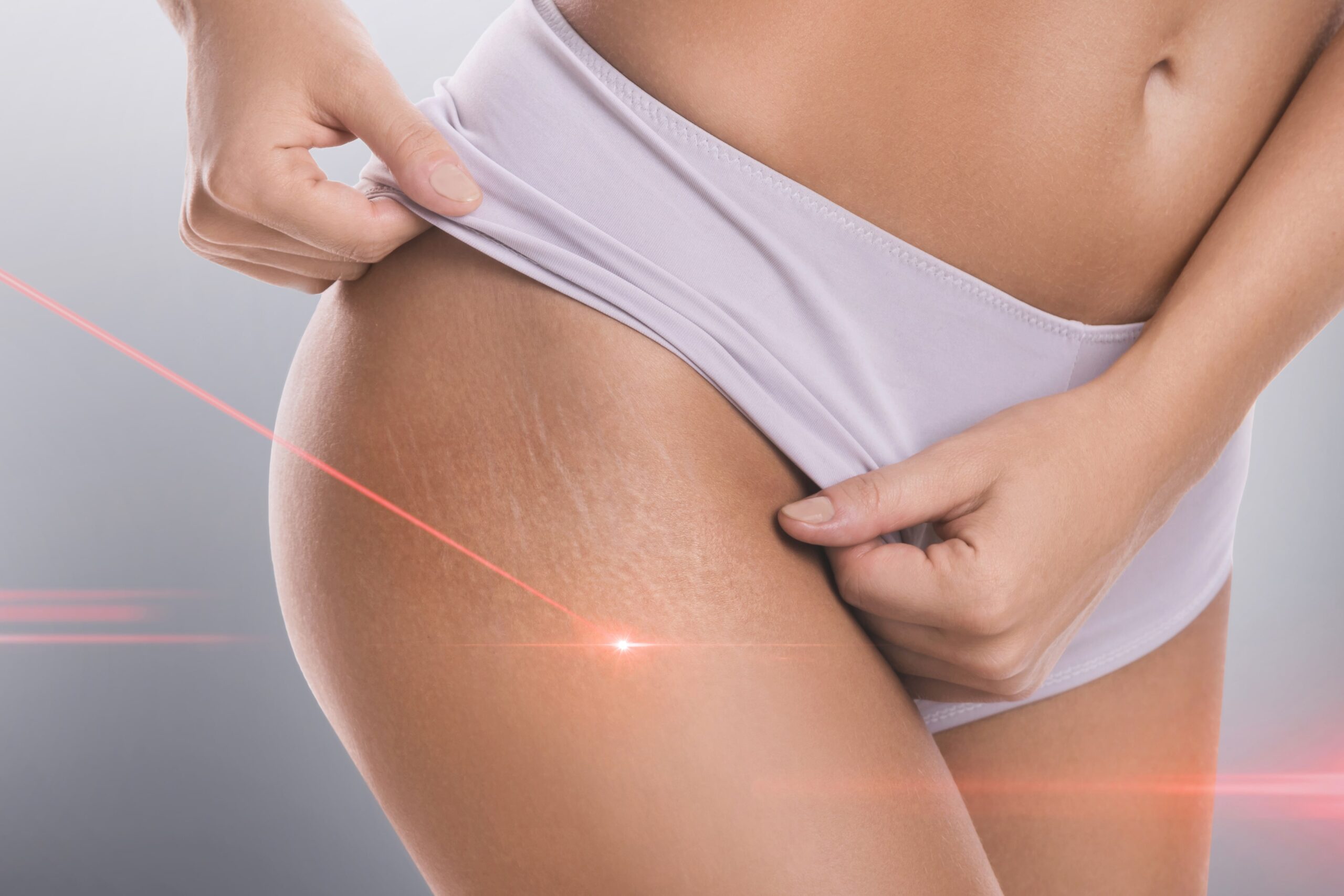 How Effective Is Laser Stretch Mark Removal?
